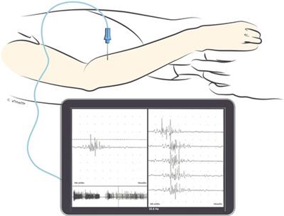 Assessment, patient selection, and rehabilitation of nerve transfers